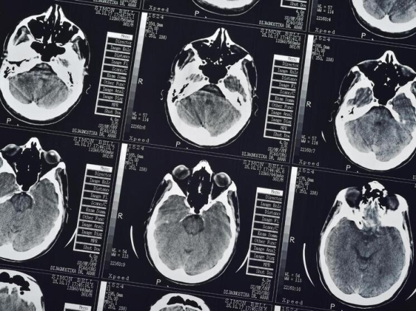 Ученые выявили способность мозга выбирать место для включения «обезболов»