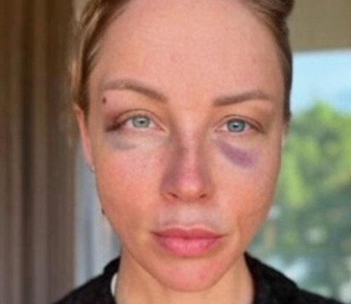 Полина Диброва опровергла сделанные ей пластические операции Полина Диброва опровергла сделанные ей пластические операции