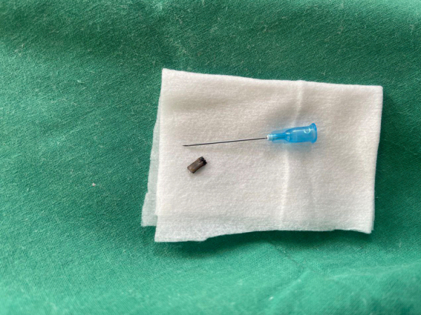 Житель Подмосковья едва не лишился руки из-за куска стружки