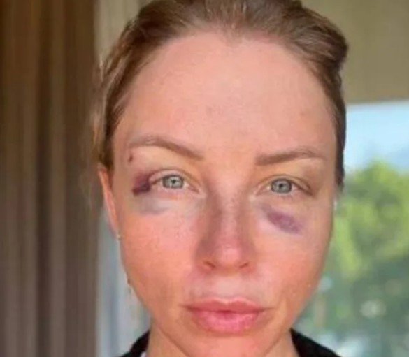 Екатерина Гордон прокомментировала синяки на лице жены Дмитрия Диброва Екатерина Гордон прокомментировала синяки на лице жены Дмитрия Диброва